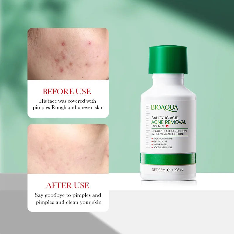 Sérum Anti-Acné à l'Acide Salicylique – Hydratant, Réparateur & Purifiant